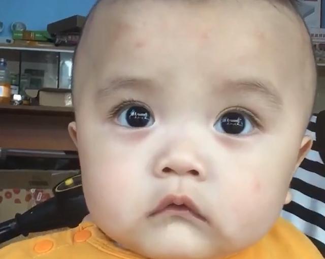 广东一萌娃一觉醒来头上长了一圈包，网友心疼：蚊子一家来开餐吗
