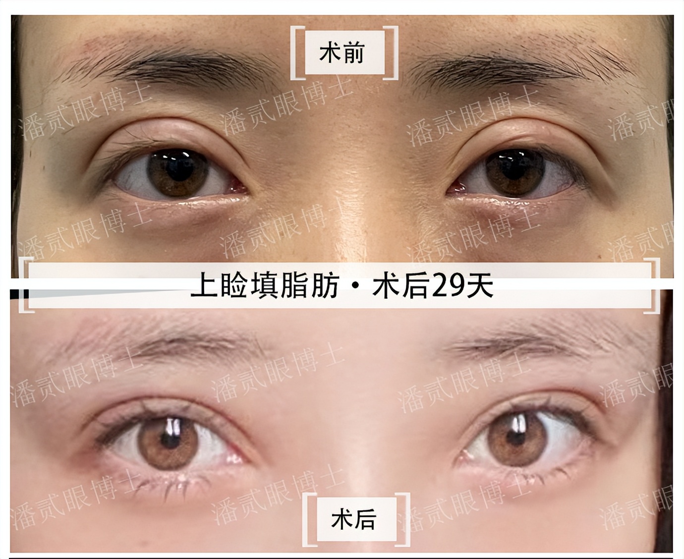 割双眼皮失败女的视频最新,割双眼皮失败女网红