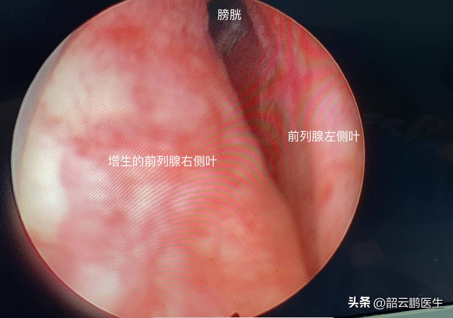 针灸治疗前列腺增生多长时间见效,前列腺增生的用药区别
