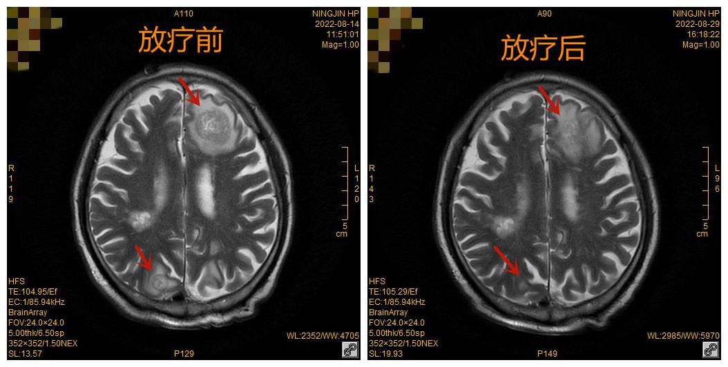 放疗治疗颈部癌症的效果,放疗根治食管癌
