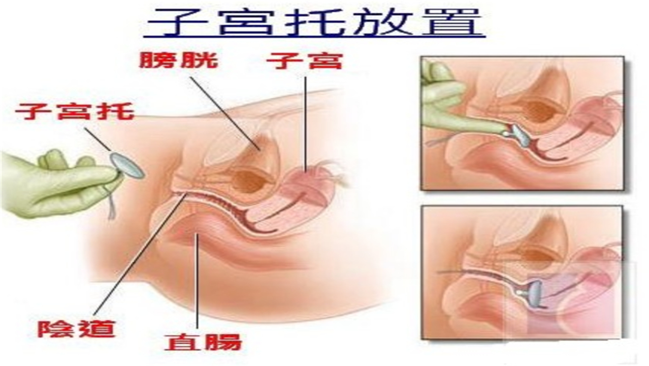 阴挺的病因与治疗,阴挺的含义