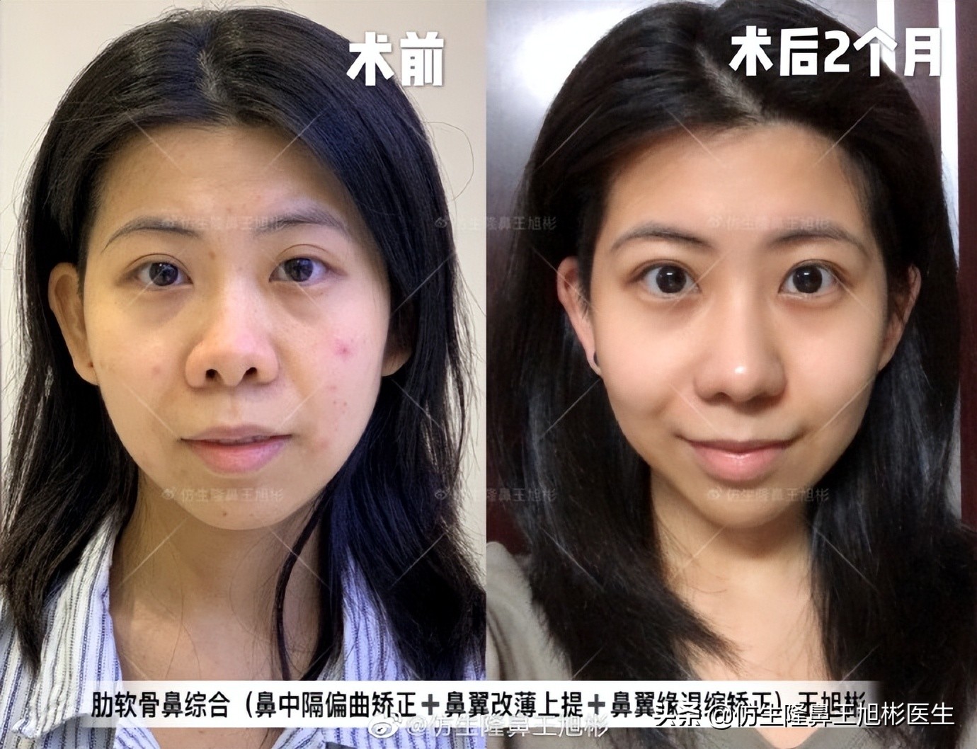 做一次鼻头缩小要多少钱好,可以只做鼻头缩鼻翼吗