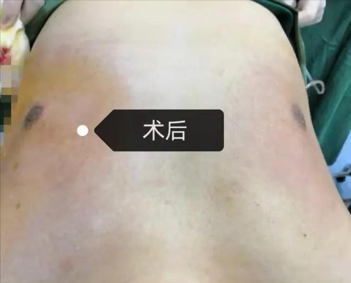 男生胸部太大的原因,男生的胸部大的原因