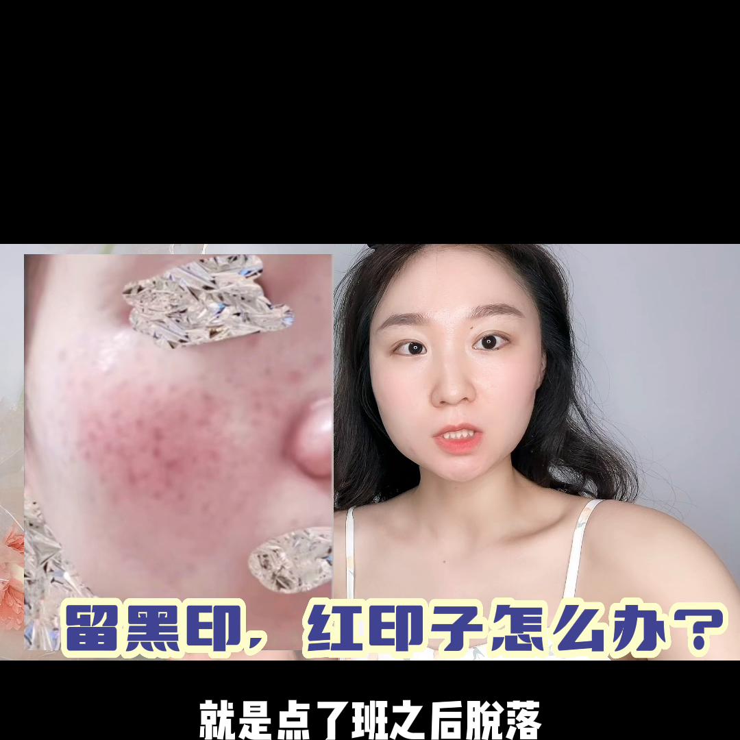 斑掉了有红印子可以护肤吗,激光点痣掉痂后红印子可以护肤吗