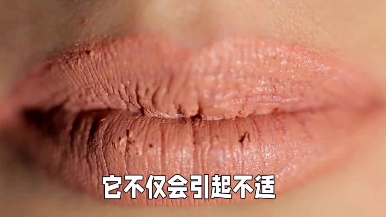 教你一招解决嘴唇干裂脱皮,嘴唇干裂脱皮怎么办有妙招