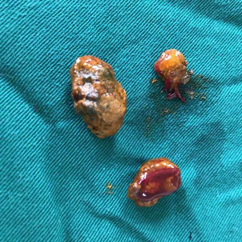 出现血尿并伴有腰疼什么原因,结石血尿腰痛怎么办啊