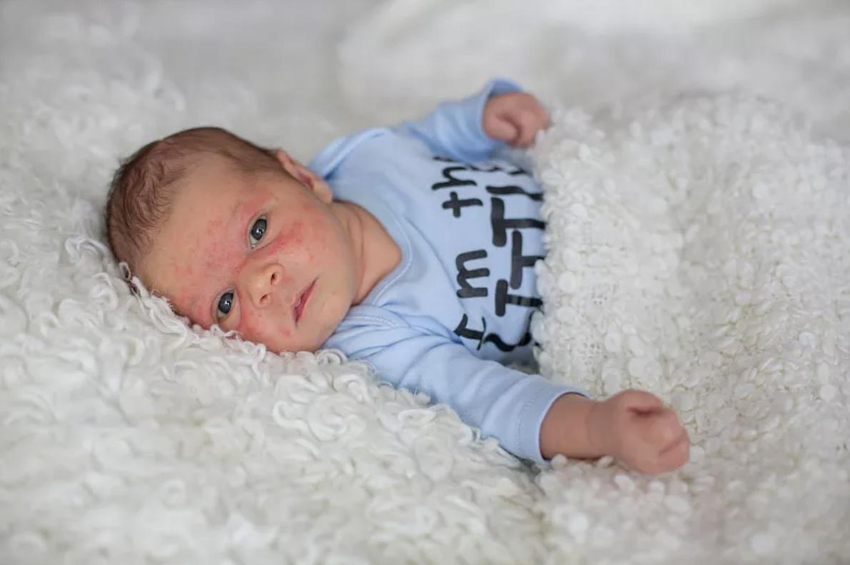 湿疹反复发作如何除根应做何检查,2个月宝宝湿疹反复发作如何除根