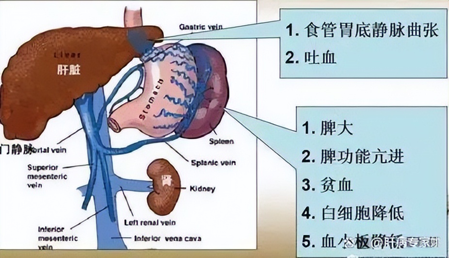 治肝硬化肝病最好的中医,肝硬化喝中药活血化瘀的表现