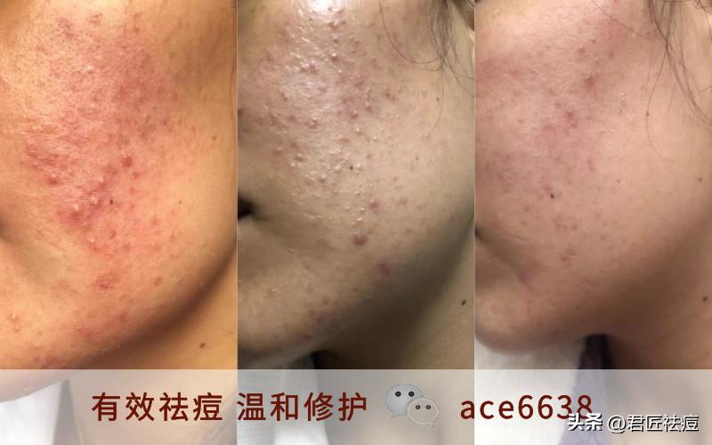 油皮痘痘怎么快速消除,油皮痘肌如何快速消除