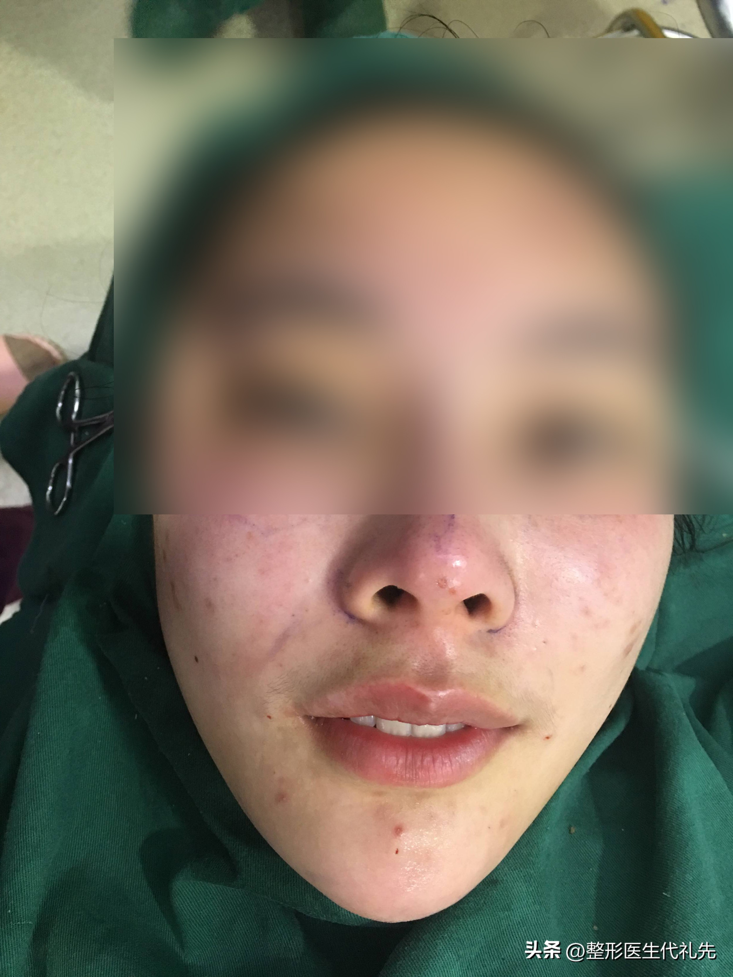 面部法令纹怎么去除,去除法令纹的日常方法