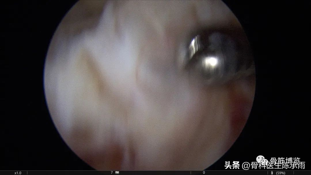 内侧半月板前角囊肿,关节镜下内侧半月板部分切除术