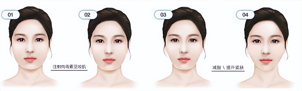 打完瘦脸针和不打瘦脸针的区别,瘦脸针要打多少剂量才能有效瘦脸