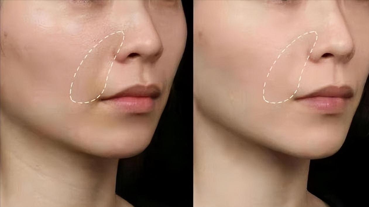 面部提升还有法令纹可以做拉皮吗,脸部提升去法令纹有用么