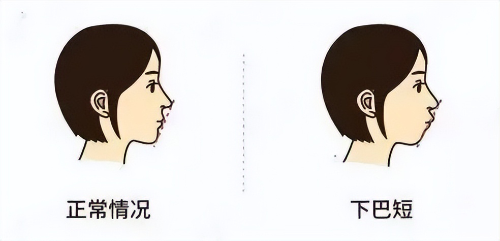 深覆颌深覆盖什么情况下不用矫正,深覆盖和深覆颌哪个严重些