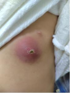 小孩皮肤有个红疙瘩里边有点硬块,小朋友皮肤上长疙瘩有白色脓包