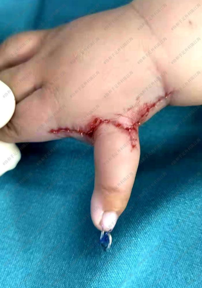 宝宝有漂浮拇指会聪明吗,漂浮拇指宝宝需要做手术吗