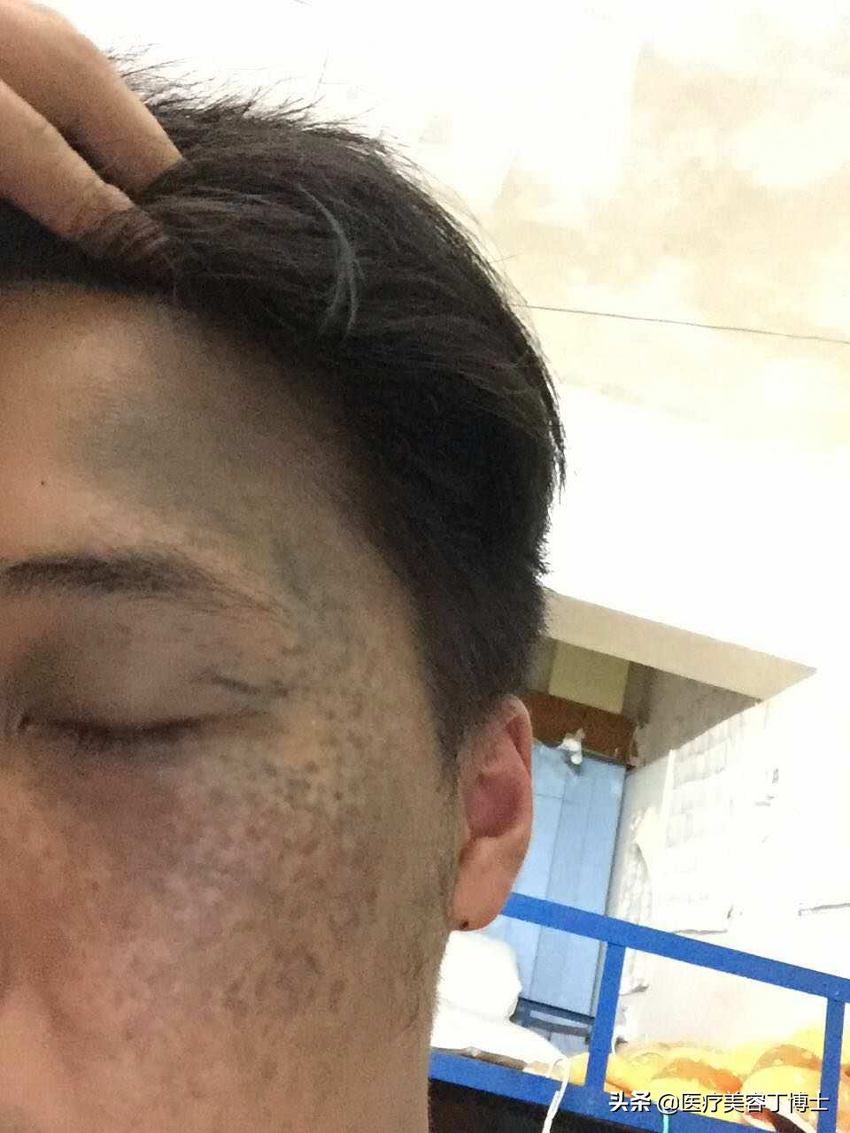 太田痣是怎么形成,太田痣是怎么形成的