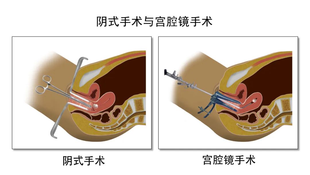 一文带你了解阴道手术和阴道镜手术