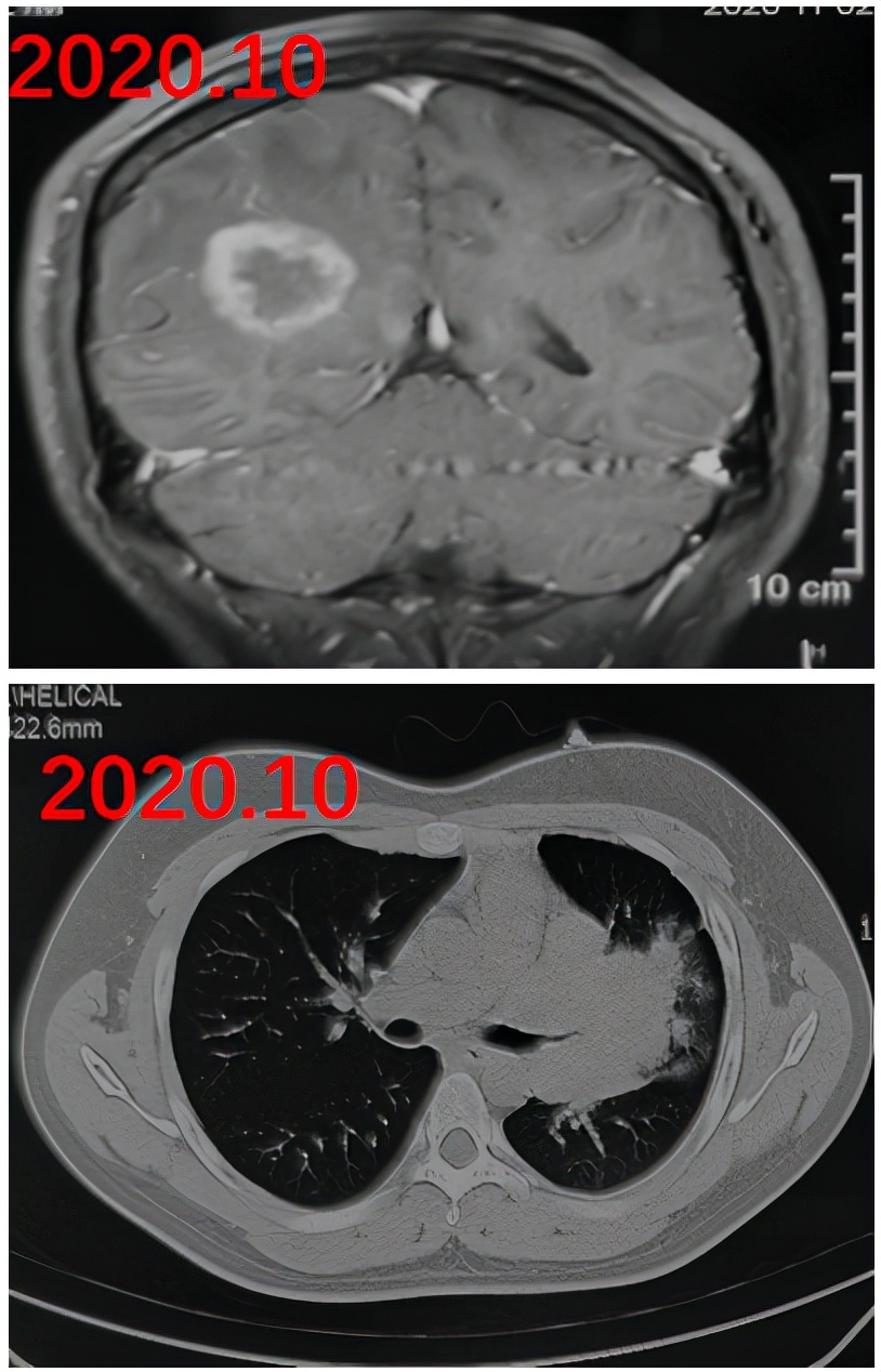 免疫缺陷病会并发什么病,什么是免疫缺陷肺部感染