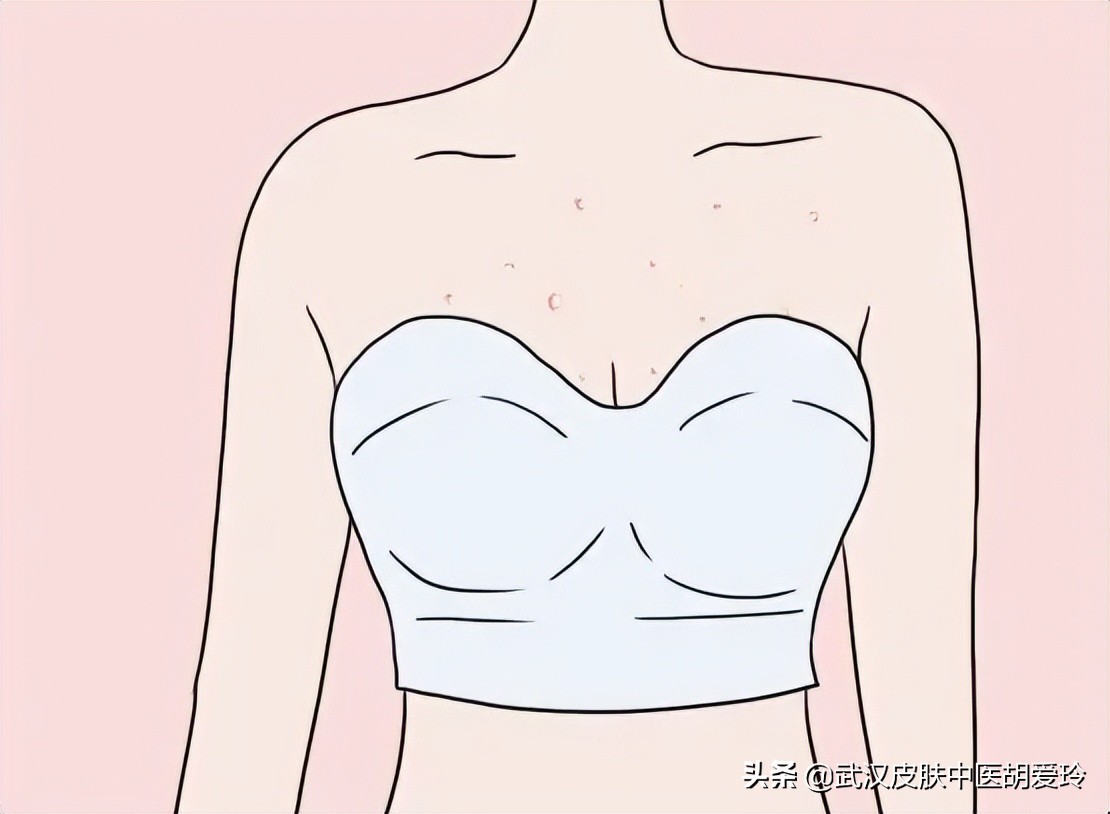 胸上起了些痘痘特别痒反复发作,脖子胸上长了好多痘痘是怎么回事