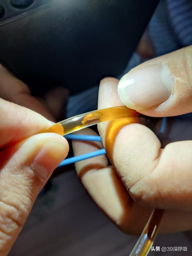 吃鱼生一年有多少人得寄生虫病,一男子吃鱼生肝生寄生虫