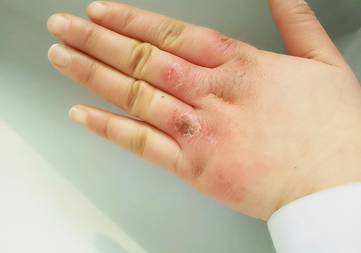 如何摆脱冬天的冻疮烦恼,冬天脚生冻疮怎么办