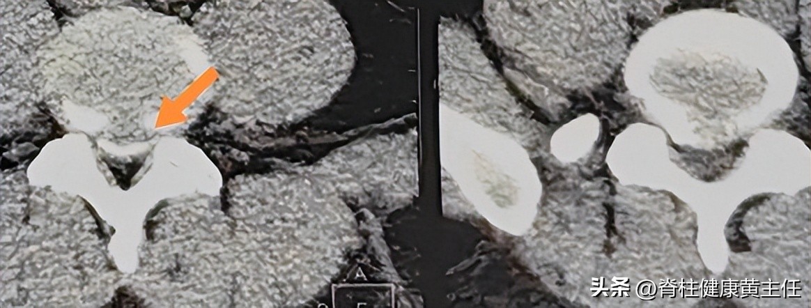 腰间盘突出压迫腿疼怎么治疗,腰间盘突出坐骨神经痛左臀酸痛