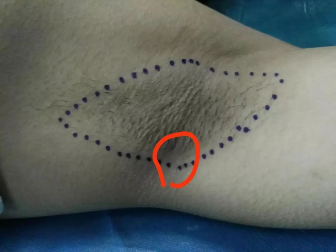 夏天狐臭味道怎么消除,夏日怎样巧祛腋臭