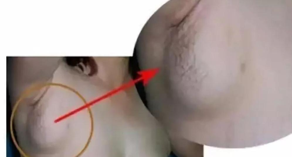 腋窝长了硬块是艾滋病吗,腋下有肿块有可能是艾滋病吗