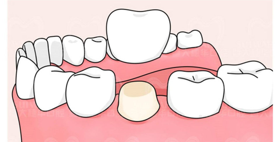 根管治疗为什么只要400块,有多少人接受过根管治疗
