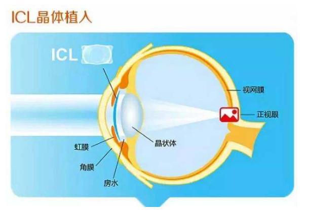 高度近视怎么办这些知识你该知道,近视100度怎么缓解近视