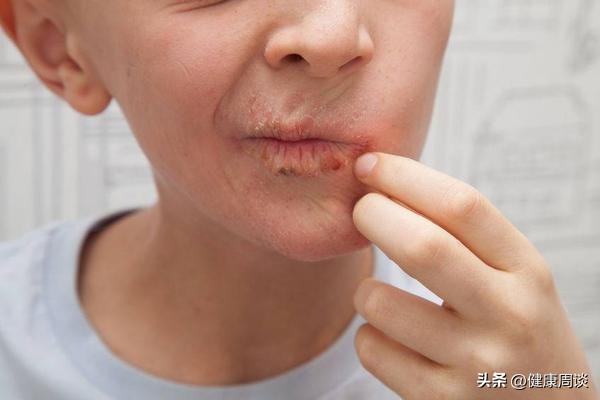 熬夜上火嘴里苦嘴臭怎么办,身体老上火怎么回事嘴还苦