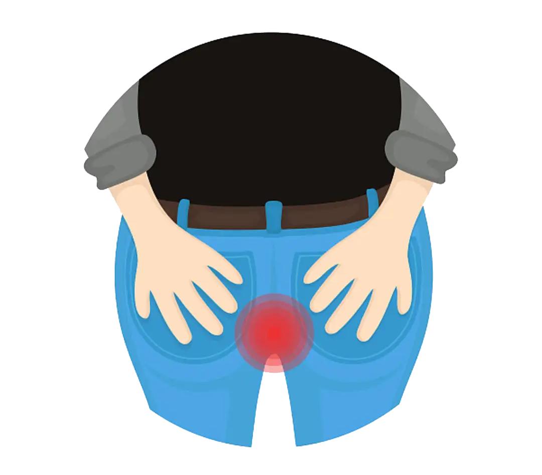 菊花痒到坐立难安?可能是肛毛太多惹的祸