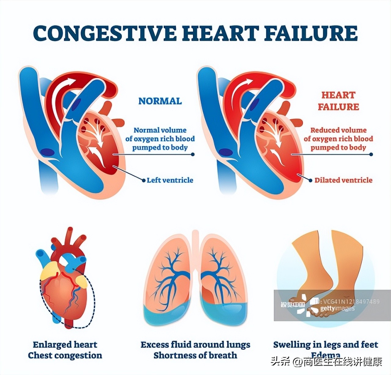 降糖药达格列净长期吃有什么害处,揭密降糖神药达格列净健康科普