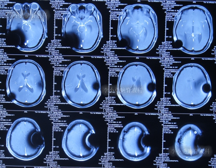 脑积水三脑室造瘘多久能恢复,脑囊虫手术后脑积水