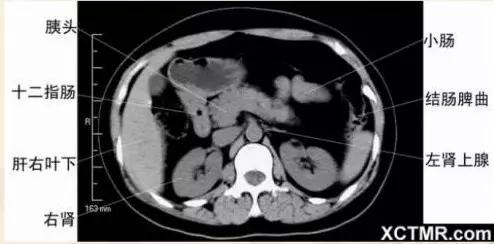 胸腹部盆腔ct主要检查什么,女性盆腔ct断层解剖结构图