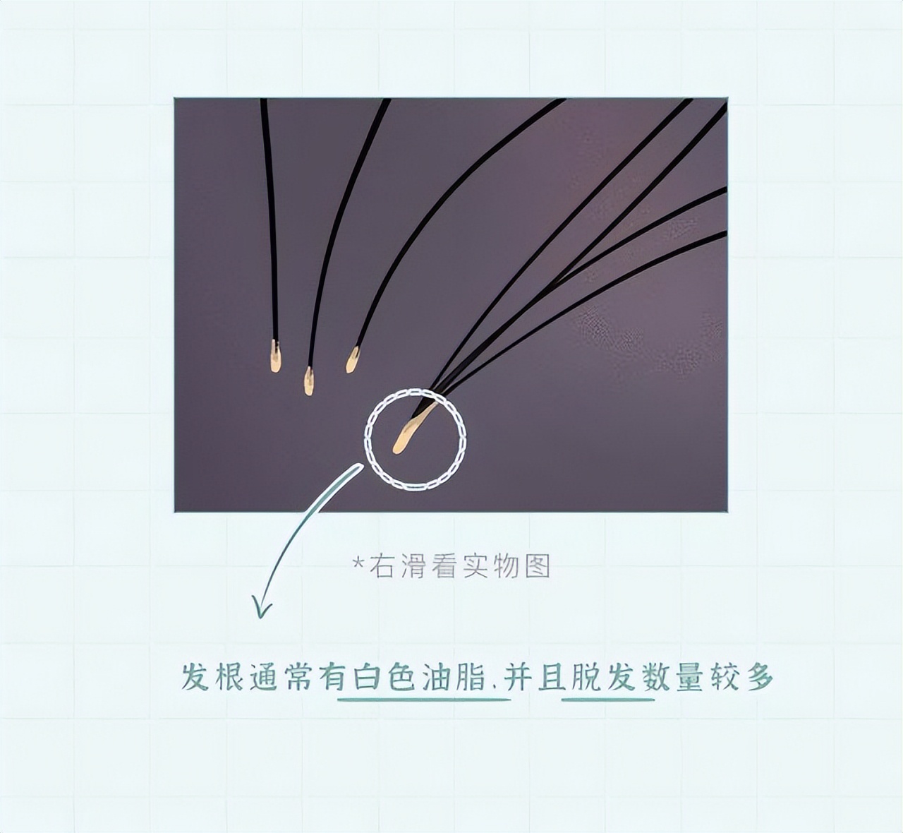 头皮上的白色颗粒,头皮上的白色颗粒是虱子吗