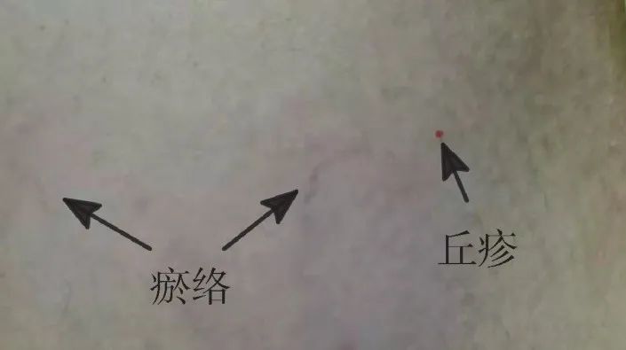 针灸治疗斑秃、乳房胀痛、斑秃、甲状腺结节、贝尔麻痹