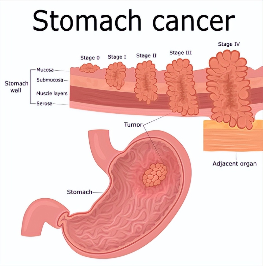 胃病的罪魁祸首就是这六种因素,胃病怎么得来的视频