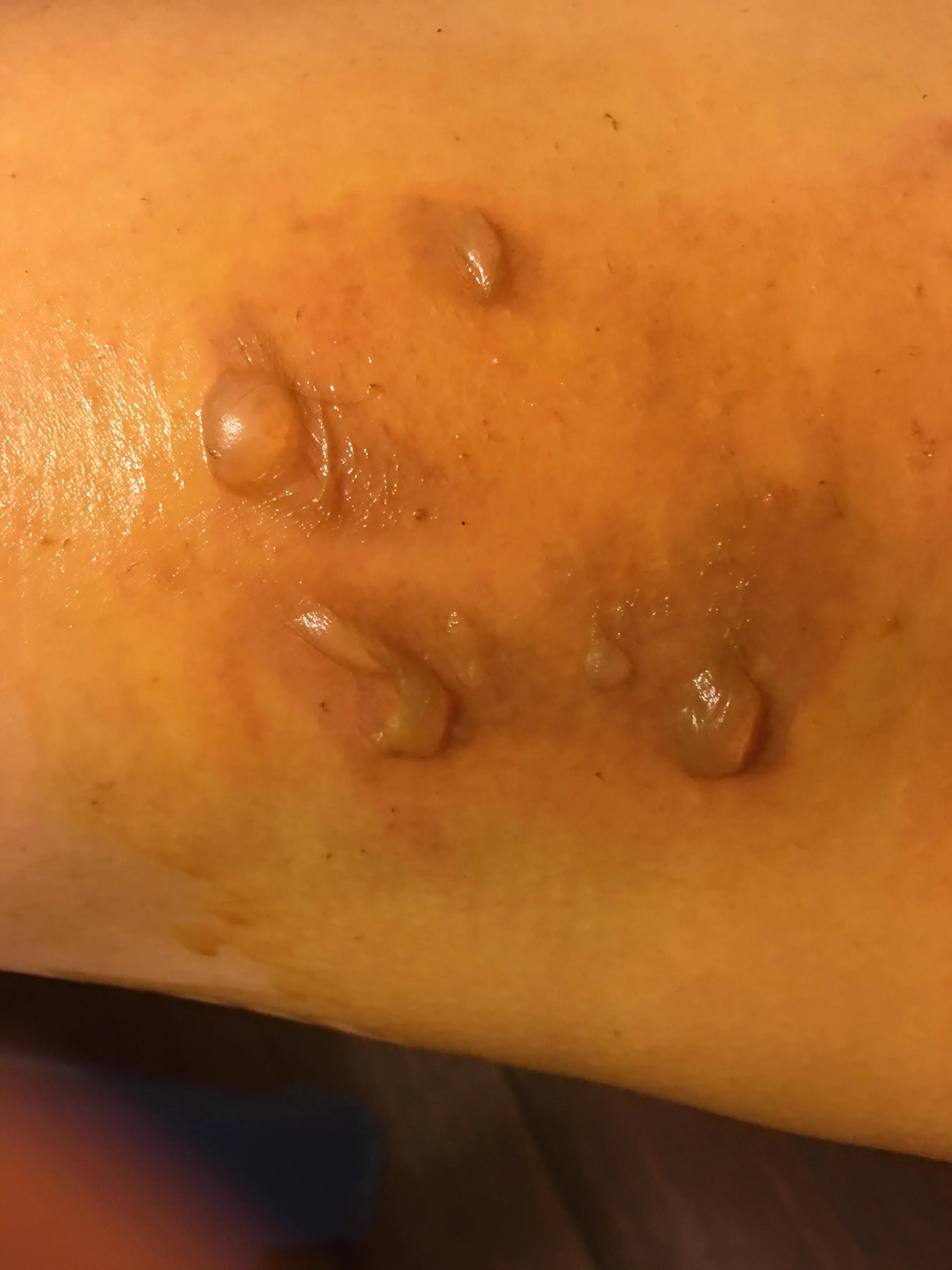 烫伤后的正确处理方法就这五个字,知识分享烫伤后的正确处理方式