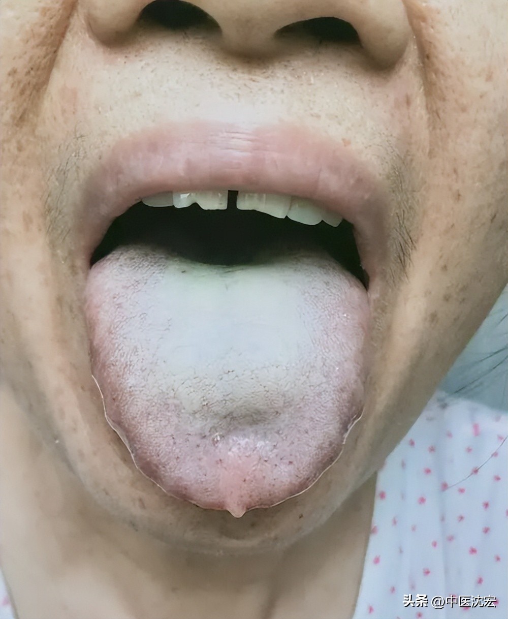 舌红阴虚有热，舌白血虚有寒，舌胖气虚有湿，中医教你从舌象看病