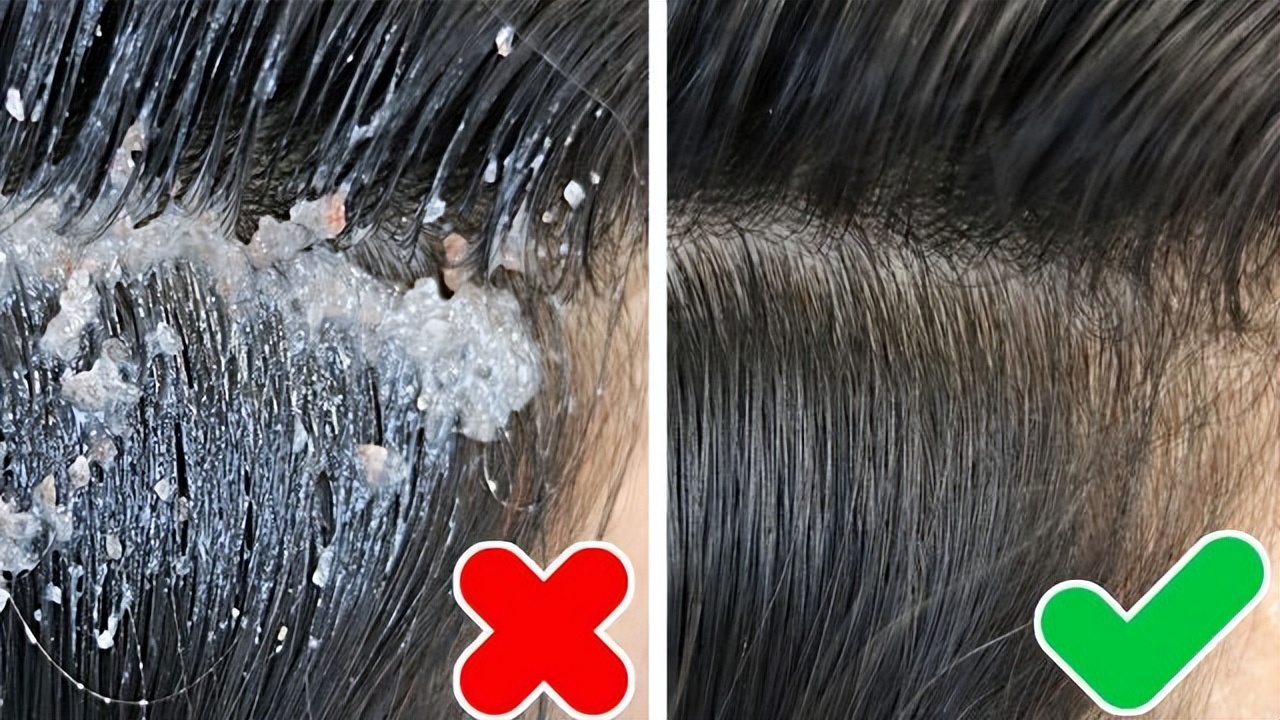 头痒头屑多掉发严重小妙招,治疗头屑头痒脱发的小妙招