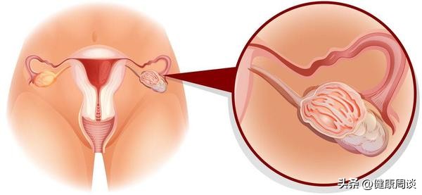 姨妈期排出大血块怎么回事,女人姨妈出血块怎么回事