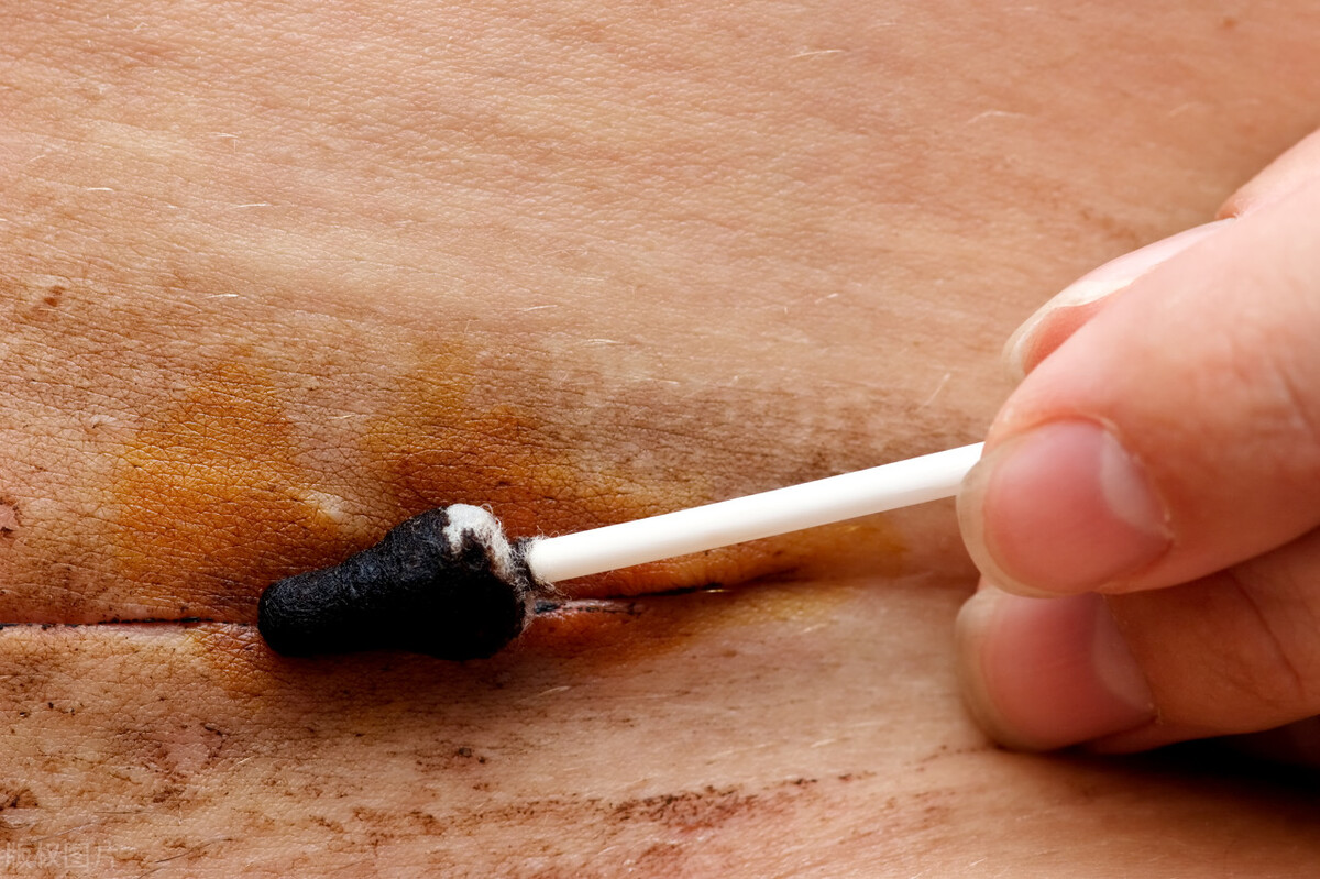 去除剖宫产疤痕增生最有效的方法,剖宫产疤痕憩室怎么去除