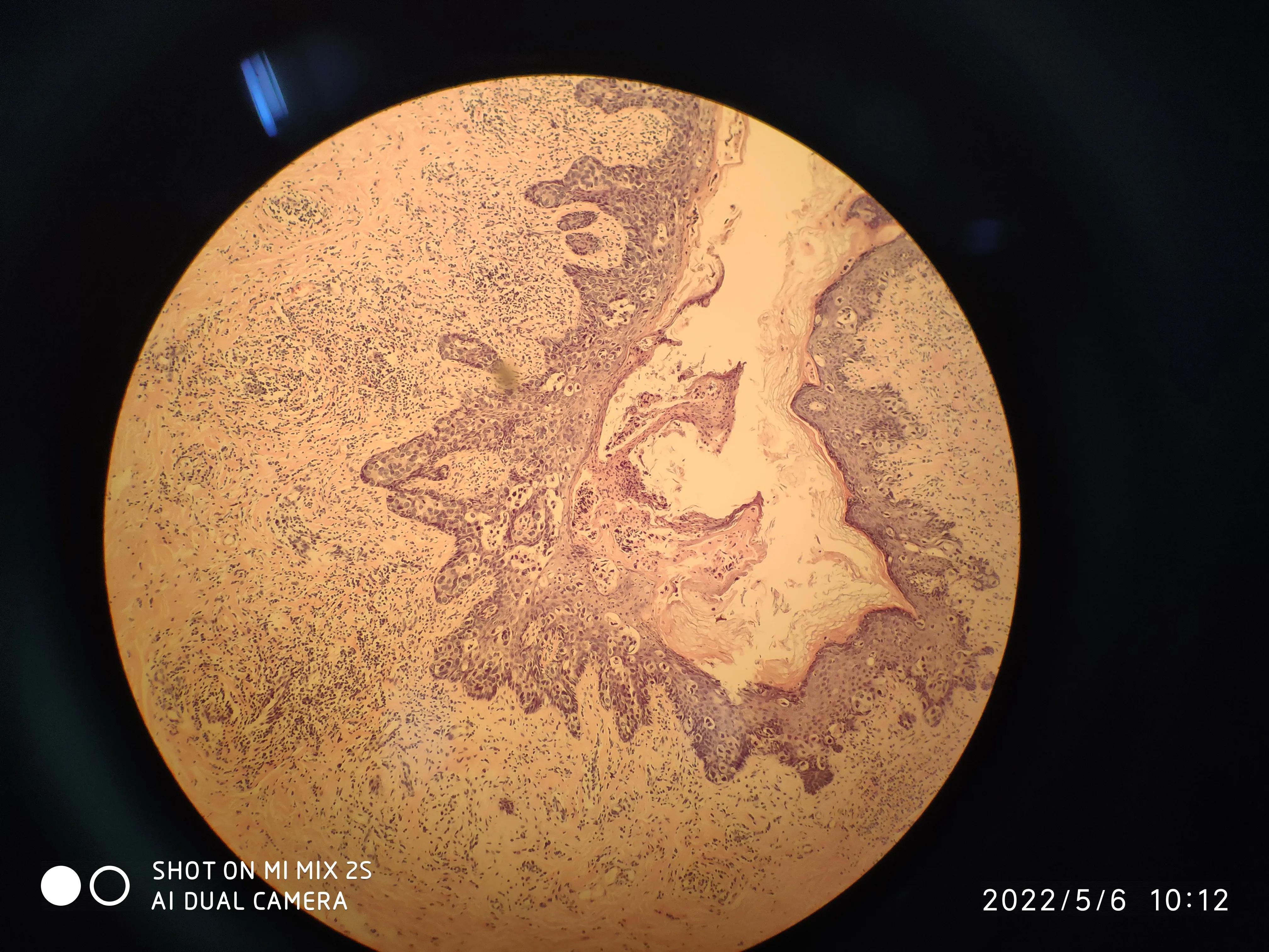 乳头湿疹样病变,乳头样湿疹