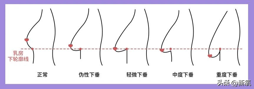 胸部略微下垂,胸部有时变大有时变小怎么回事