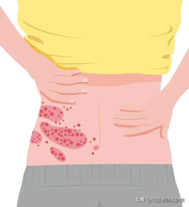 带状疱疹疼痛难忍有什么特殊药物,疼痛带状疱疹