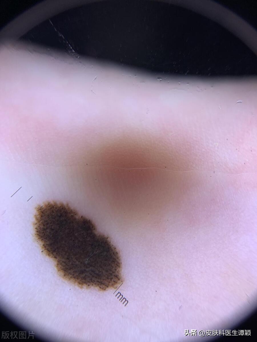 医院皮肤科医生谈痣,皮肤科色素痣科普