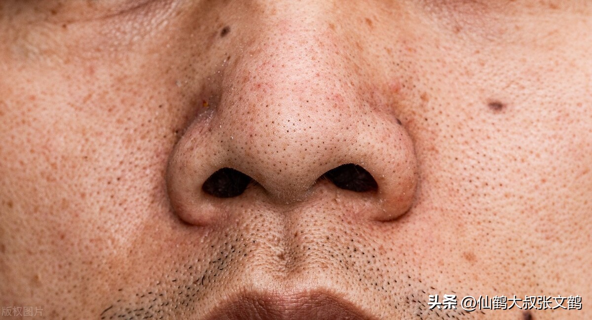 鹤叔十滴水治痘印,鹤叔淡化痘印小妙招