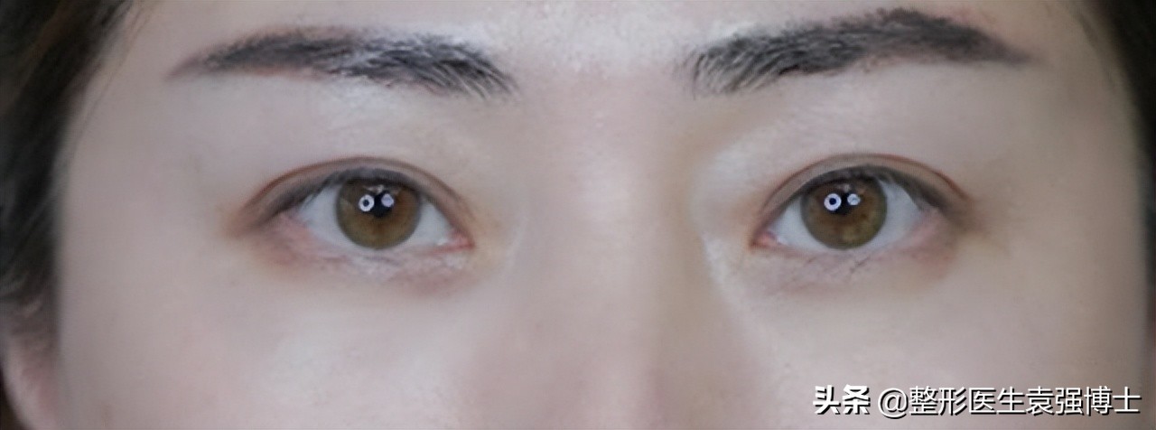 眼周年轻化手术效果可以持续多久,眼周医美项目